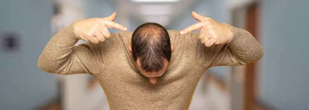 Cause Caduta dei Capelli: l’alopecia androgenetica