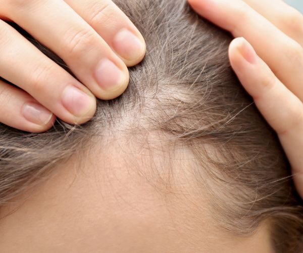 Rasare i capelli per fare il trapianto: è necessario?